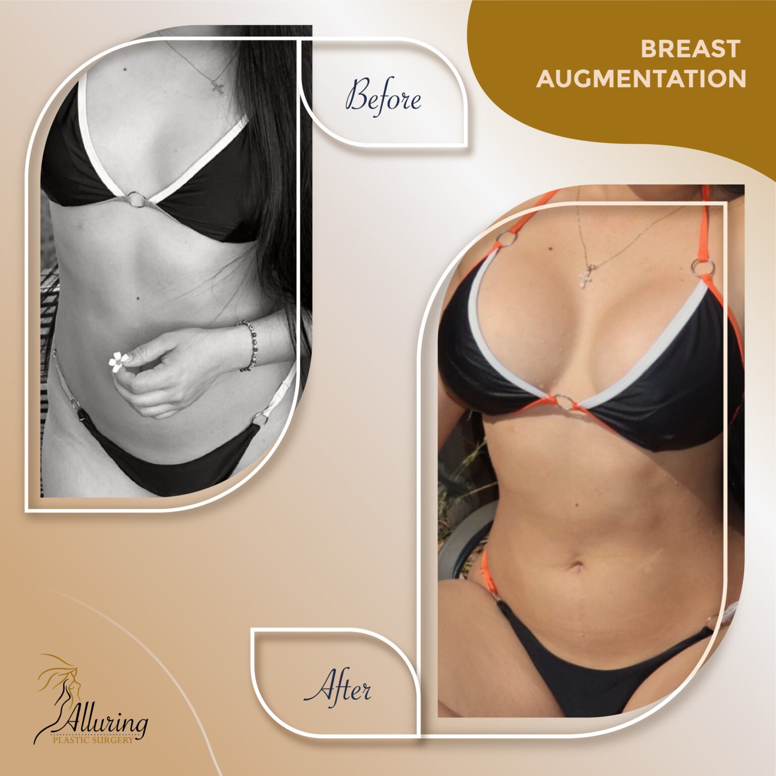 Alluring Plastic Surgery - Before & After - Breast Augmentation